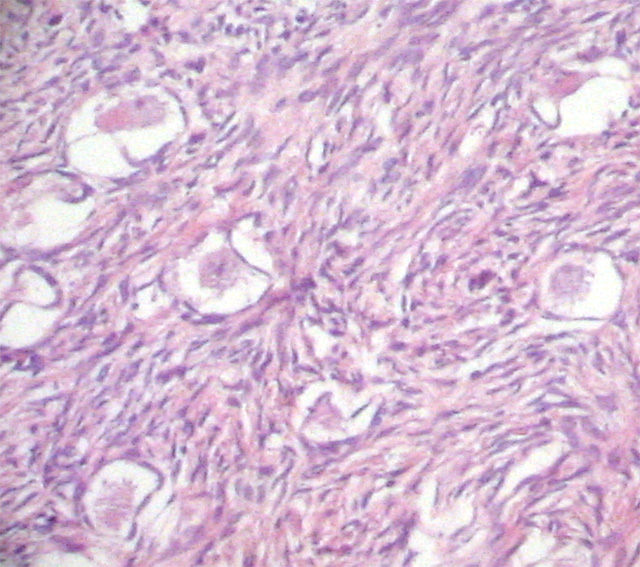 Fig.4 : Caso 2. Ovotestis-Compartimento Ovrico. - <div style=